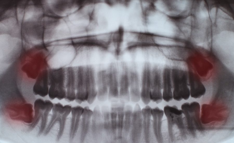 teeth-full-x-ray-FUGEHH8-copy2.jpg